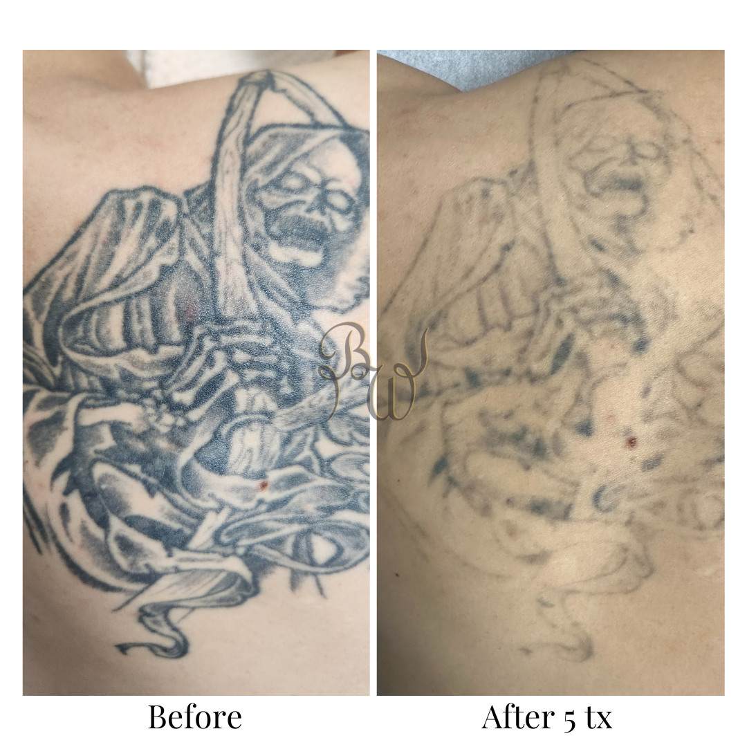 Everything You Need to Know About PicoWay Tattoo Fading and Removal Success at Bush Whacked Laser in Edmonton