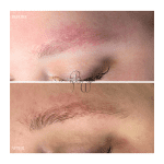 brow rehab at bush whacked laser using willow and fia