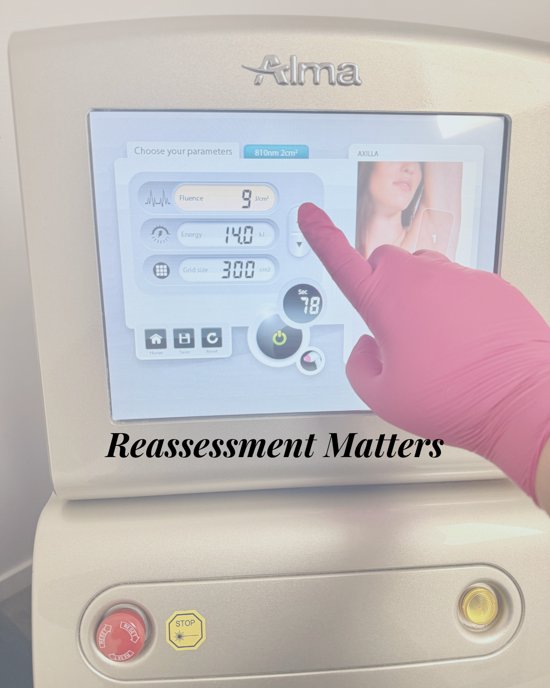 Why Laser Hair Removal Results Vary in Edmonton (And What Most Clinics Don’t Explain)