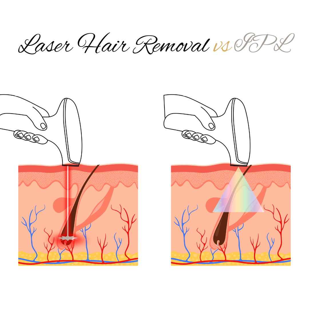 Laser Hair Removal vs IPL in Edmonton. What’s the Difference?
