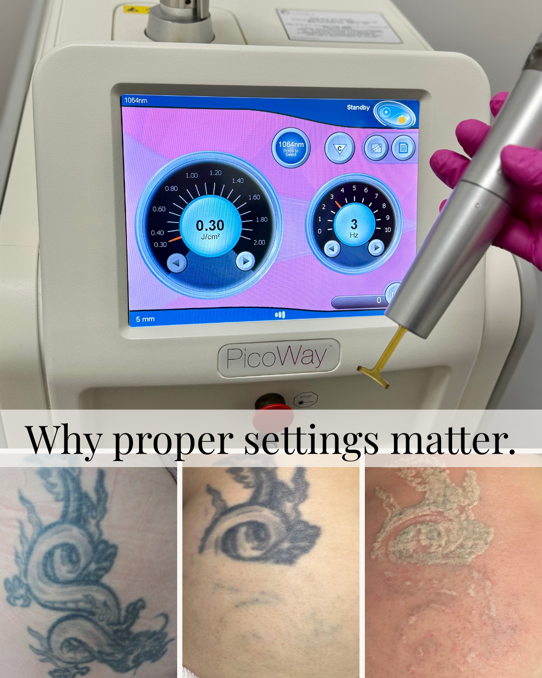 Why Some Tattoo Removal Clinics in Edmonton Use Lower Settings (And Why It Matters)