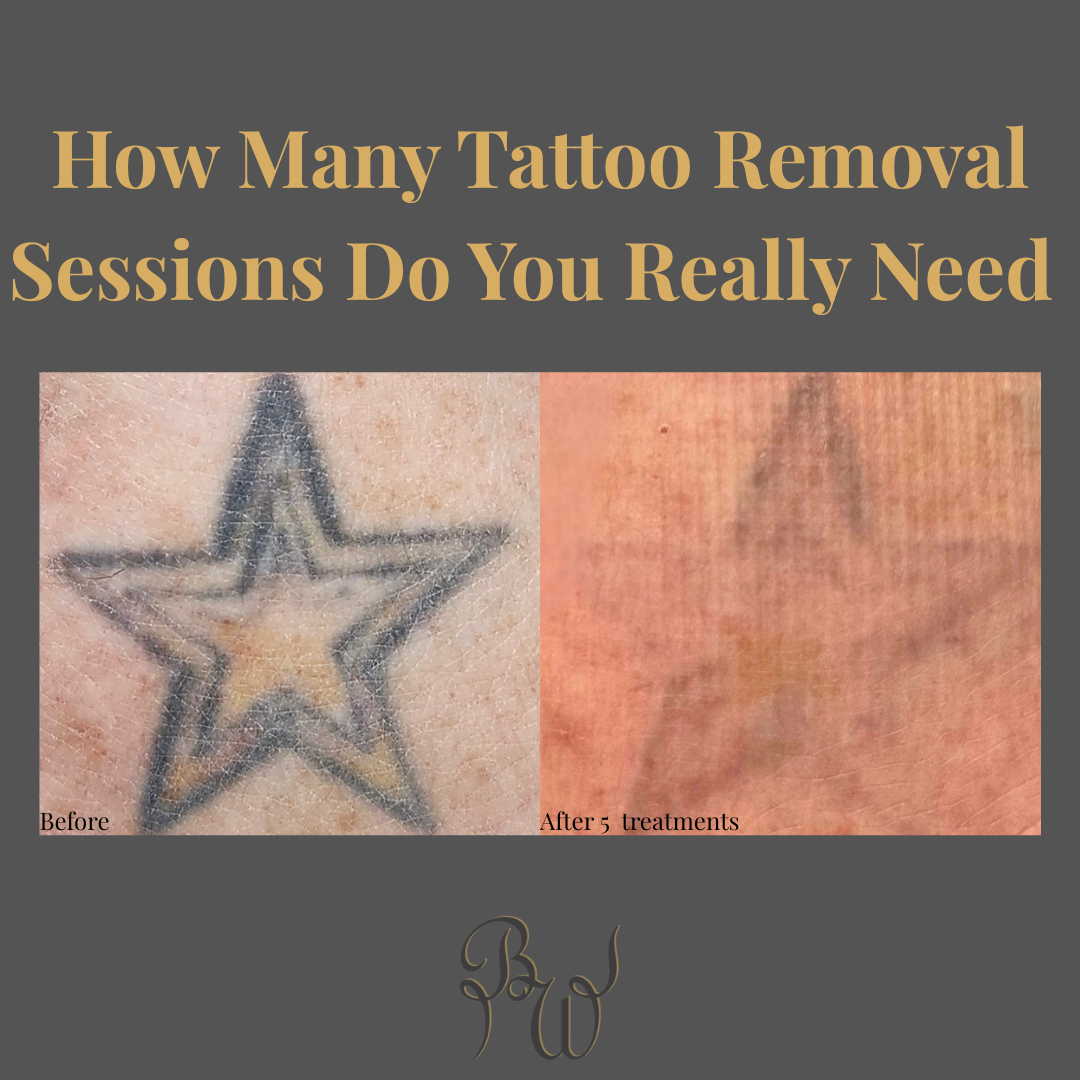 How Many Tattoo Removal Sessions Do You Really Need in Edmonton?