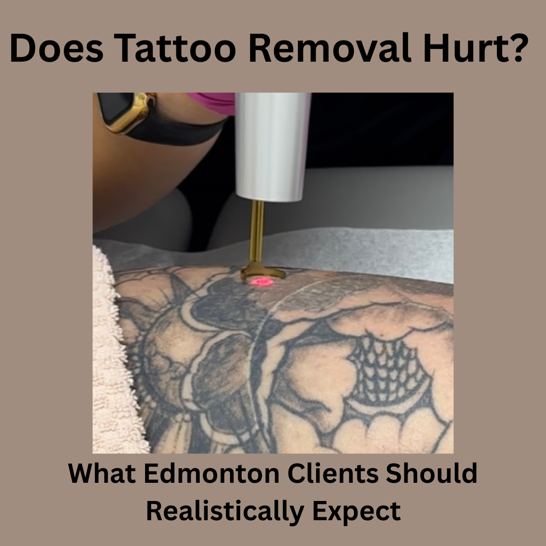 Does Tattoo Removal Hurt? What Edmonton Clients Should Realistically Expect