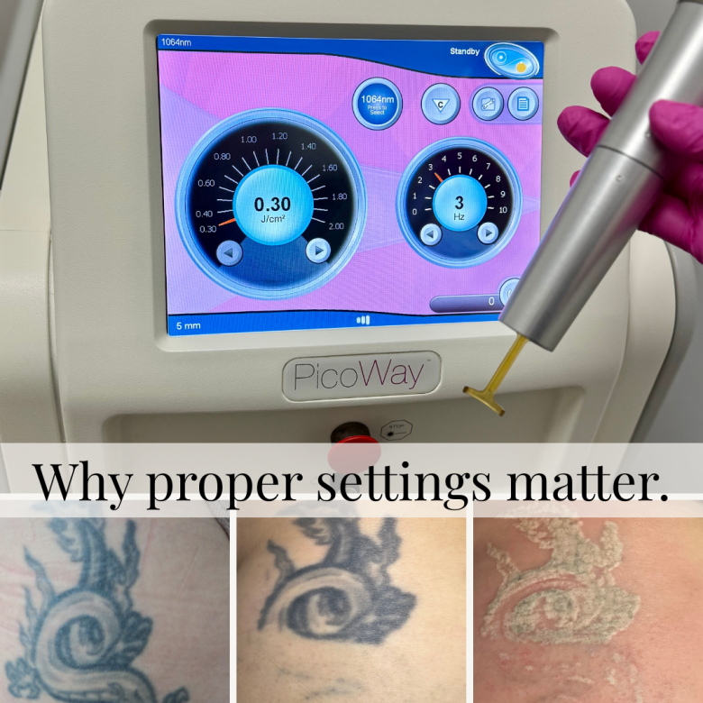 Why Some Tattoo Removal Clinics in Edmonton Use Lower Settings (And Why It Matters)